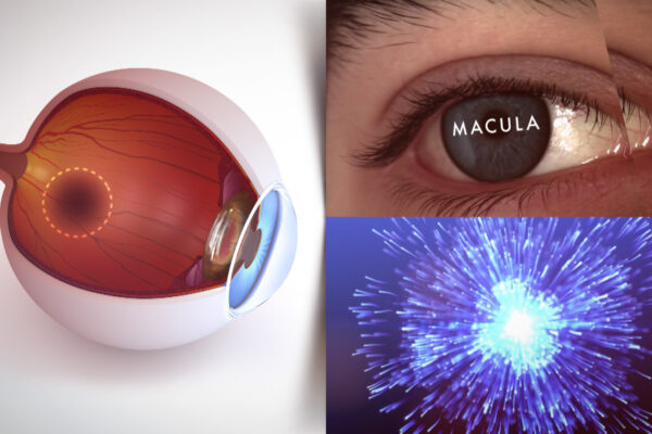 Superfoods Macula Example ©Holey&Moley Ltd